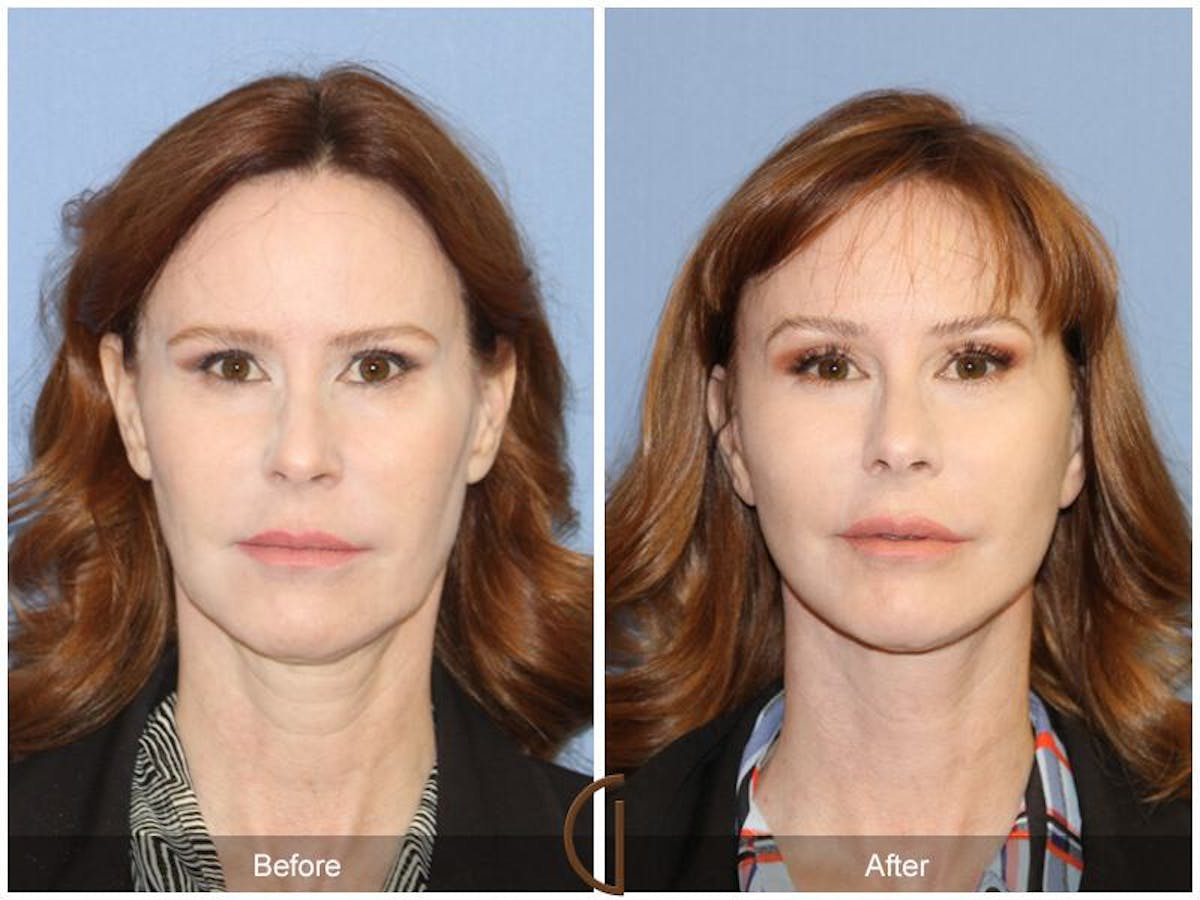 Facelift 40s Before & After Gallery - Patient 204593 - Image 2