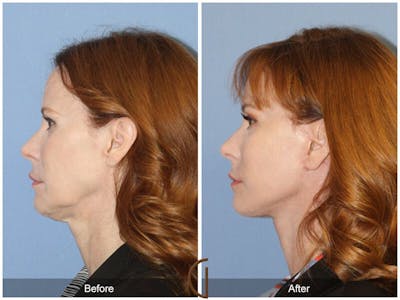 Neck Lift Before & After Gallery - Patient 403207 - Image 1