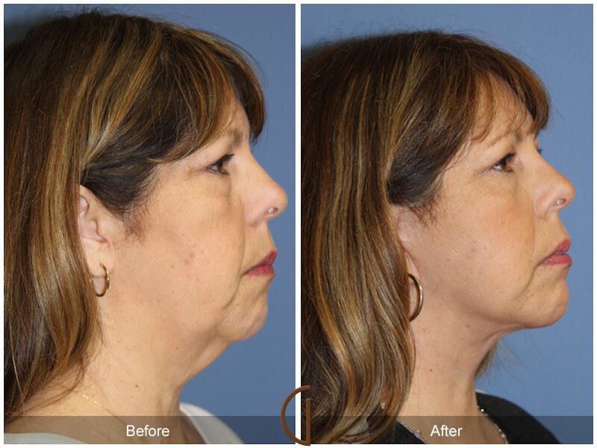 Facelift 50s Before & After Gallery - Patient 366112 - Image 3