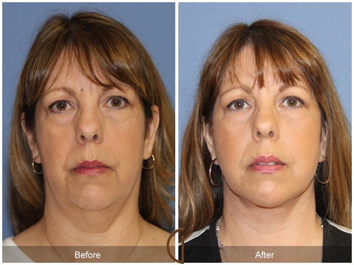 Facelift 50s Before & After Gallery - Patient 366112 - Image 2
