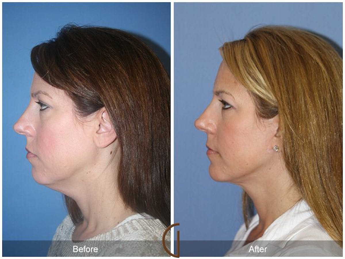 Neck Lift Before & After Gallery - Patient 419953 - Image 1