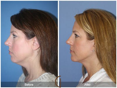Neck Lift Before & After Gallery - Patient 419953 - Image 1