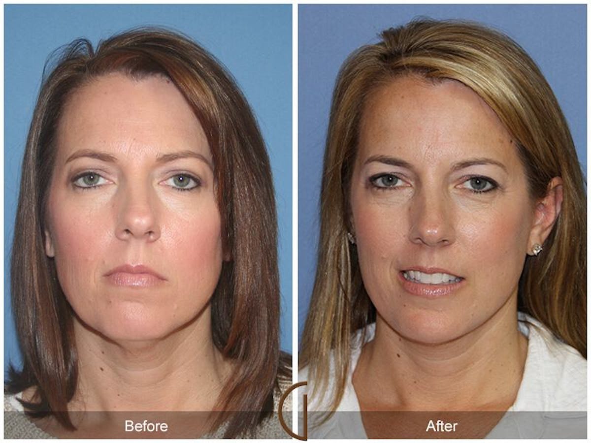 Neck Lift Before & After Gallery - Patient 419953 - Image 2