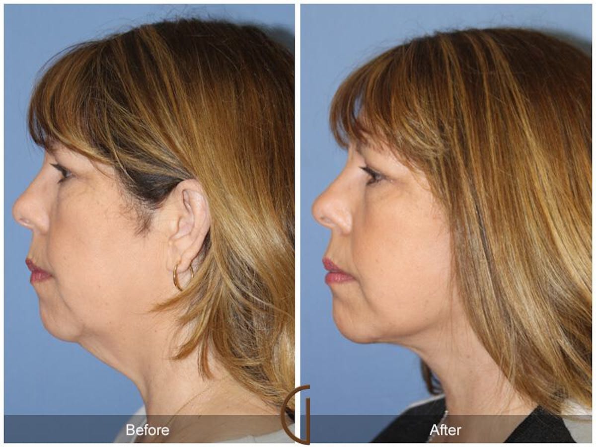 Facelift 50s Before & After Gallery - Patient 366112 - Image 1