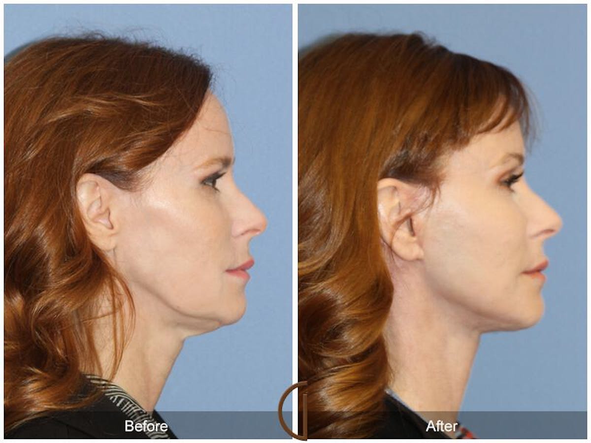 Facelift 40s Before & After Gallery - Patient 204593 - Image 3