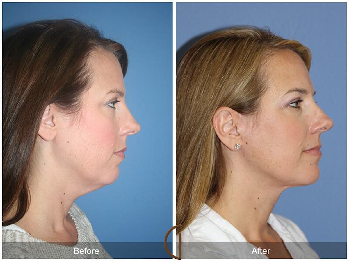 Neck Lift Before & After Gallery - Patient 419953 - Image 3