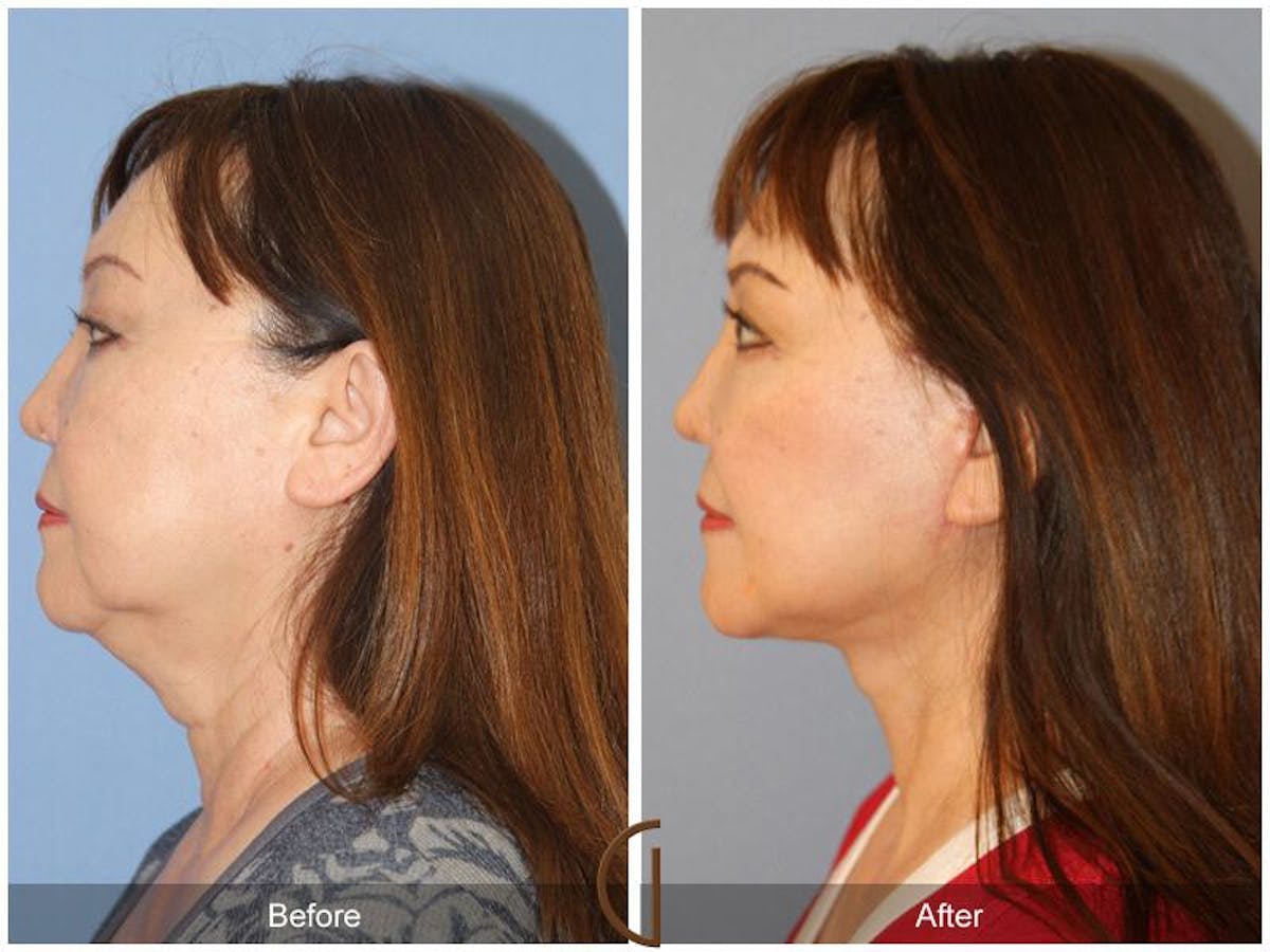 Facelift 60s Before & After Gallery - Patient 963423 - Image 1