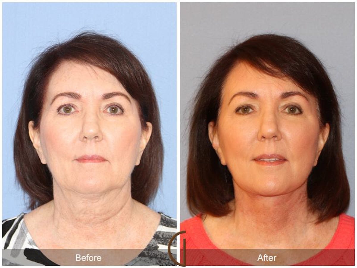 Facelift 60s Before & After Gallery - Patient 100519 - Image 2