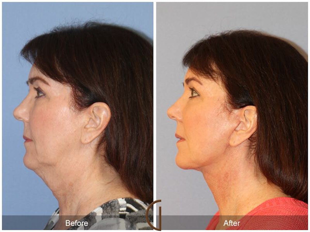 Facelift 60s Before & After Gallery - Patient 100519 - Image 1