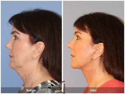 Neck Lift Before & After Gallery - Patient 239700 - Image 1