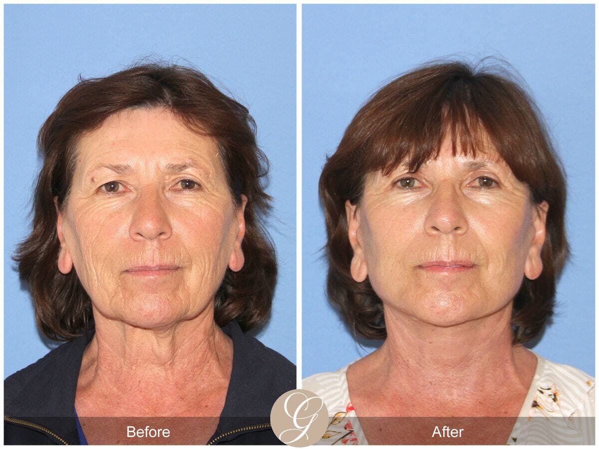 Facelift 60s Before & After Gallery - Patient 232466 - Image 2