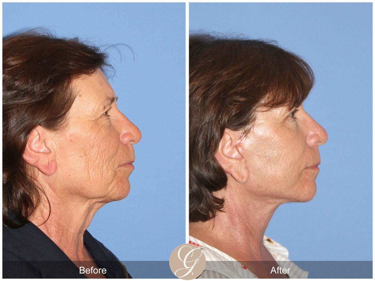 Facelift 60s Before & After Gallery - Patient 232466 - Image 3