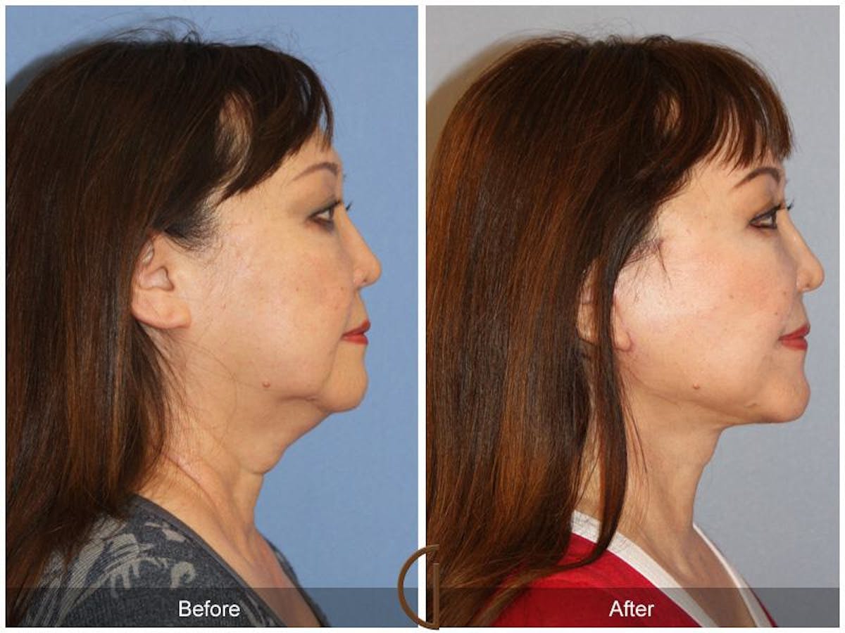 Facelift 60s Before & After Gallery - Patient 963423 - Image 3