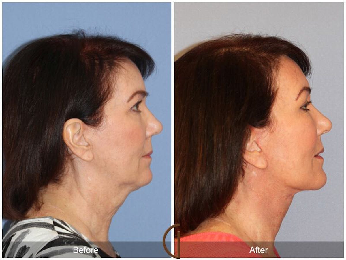 Facelift 60s Before & After Gallery - Patient 100519 - Image 3