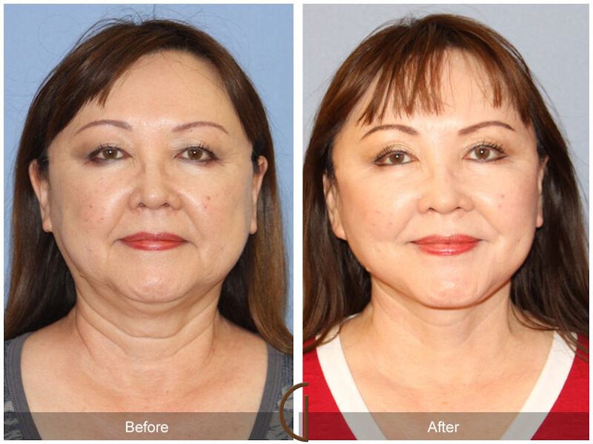 Facelift 60s Before & After Gallery - Patient 963423 - Image 2