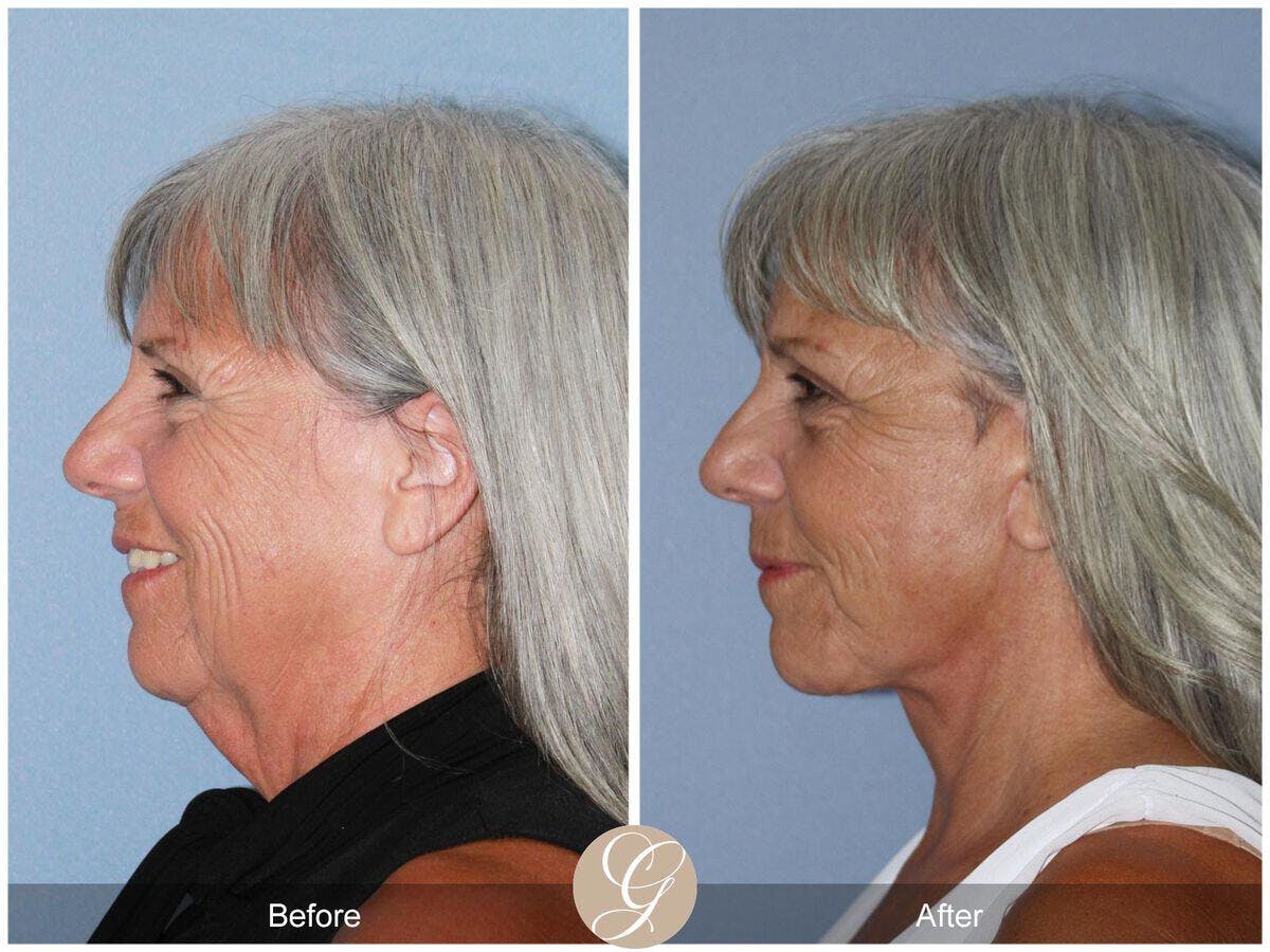Facelift 60s Before & After Gallery - Patient 239746 - Image 1