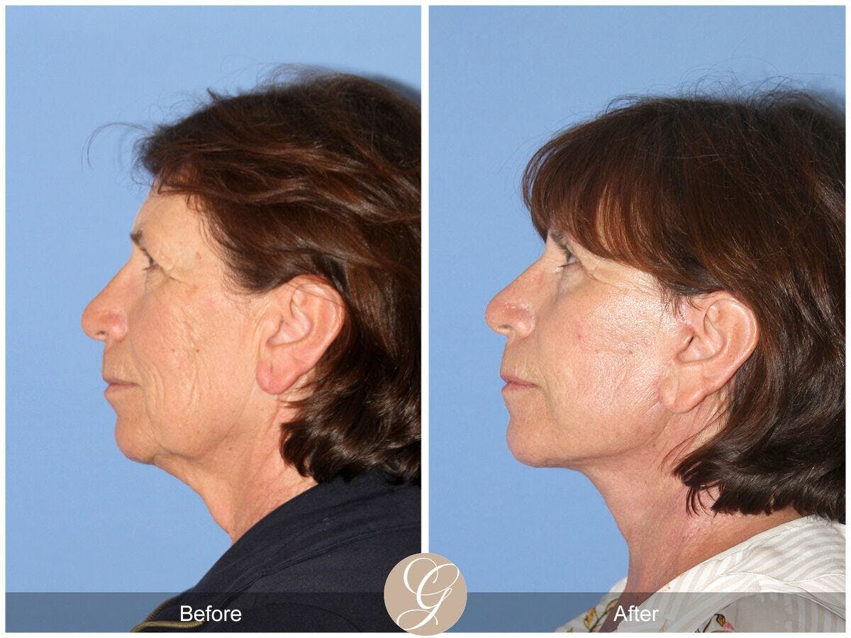 Facelift 60s Before & After Gallery - Patient 232466 - Image 1