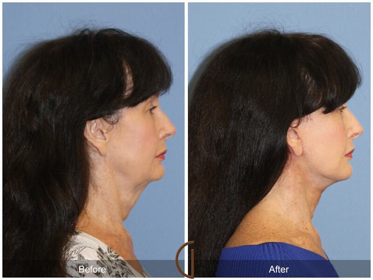 Facelift 60s Before & After Gallery - Patient 221226 - Image 3