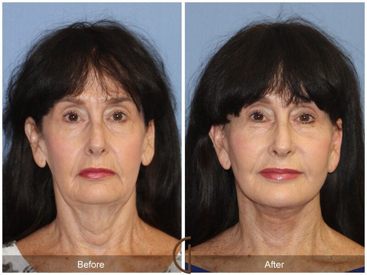 Facelift 60s Before & After Gallery - Patient 221226 - Image 2