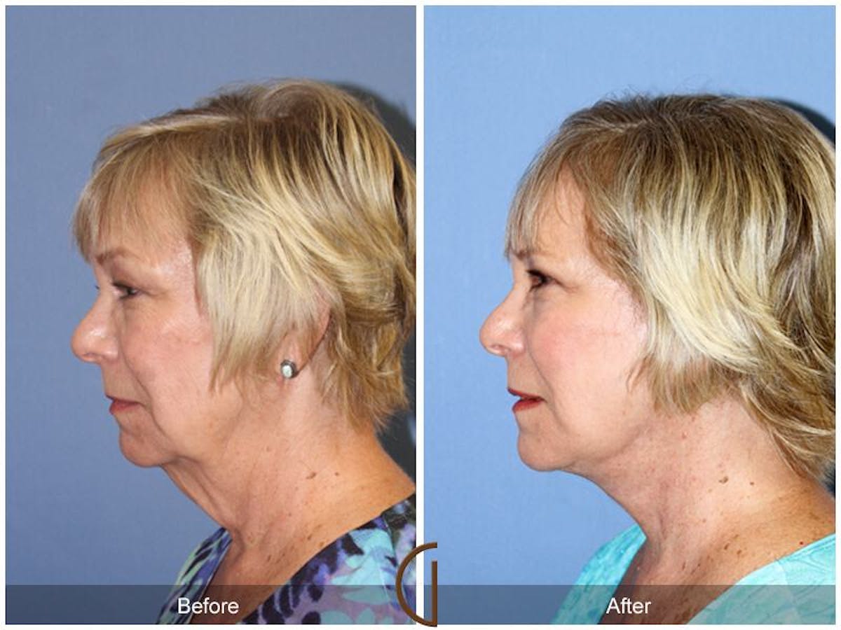 Facelift 60s Before & After Gallery - Patient 229789 - Image 1
