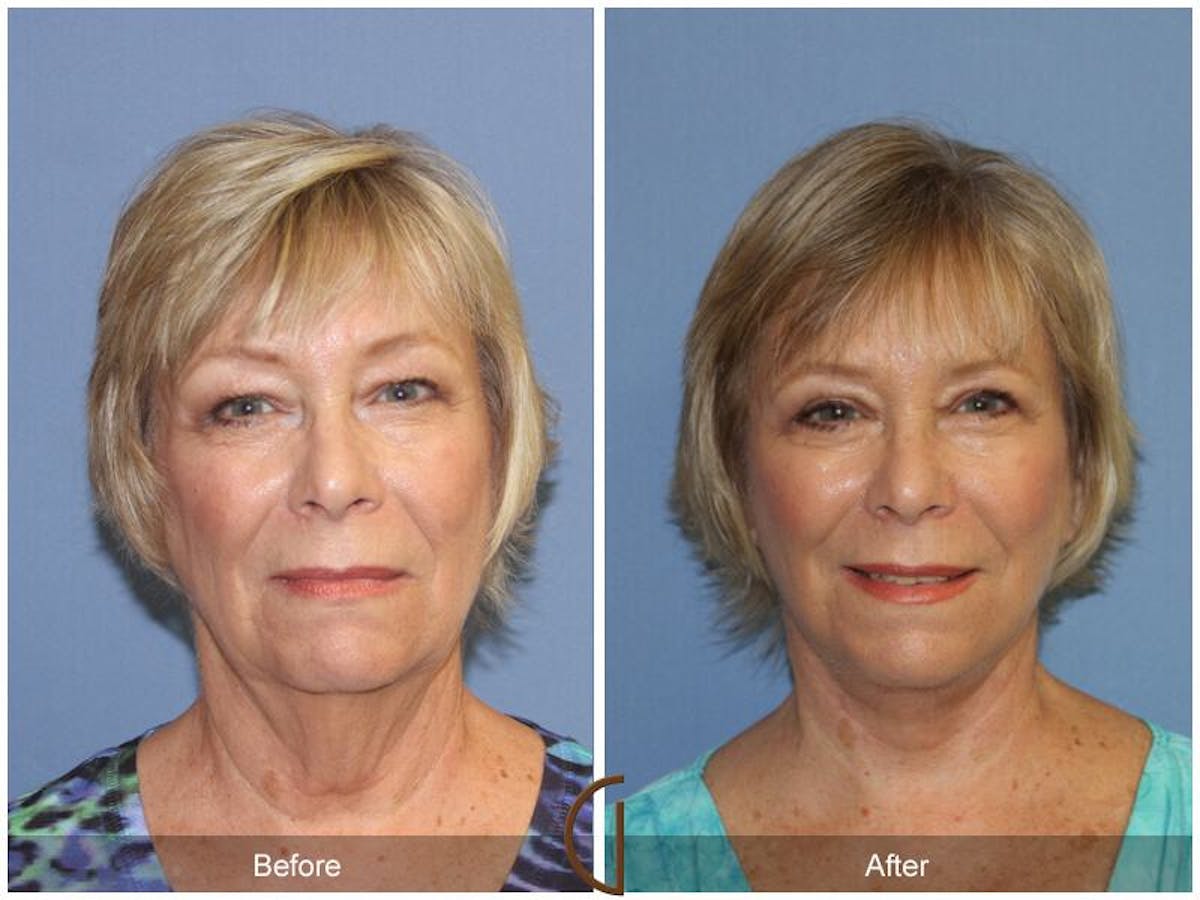 Facelift 60s Before & After Gallery - Patient 229789 - Image 2