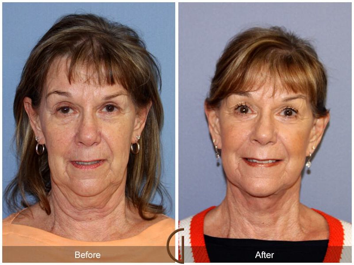 Facelift 60s Before & After Gallery - Patient 639286 - Image 2