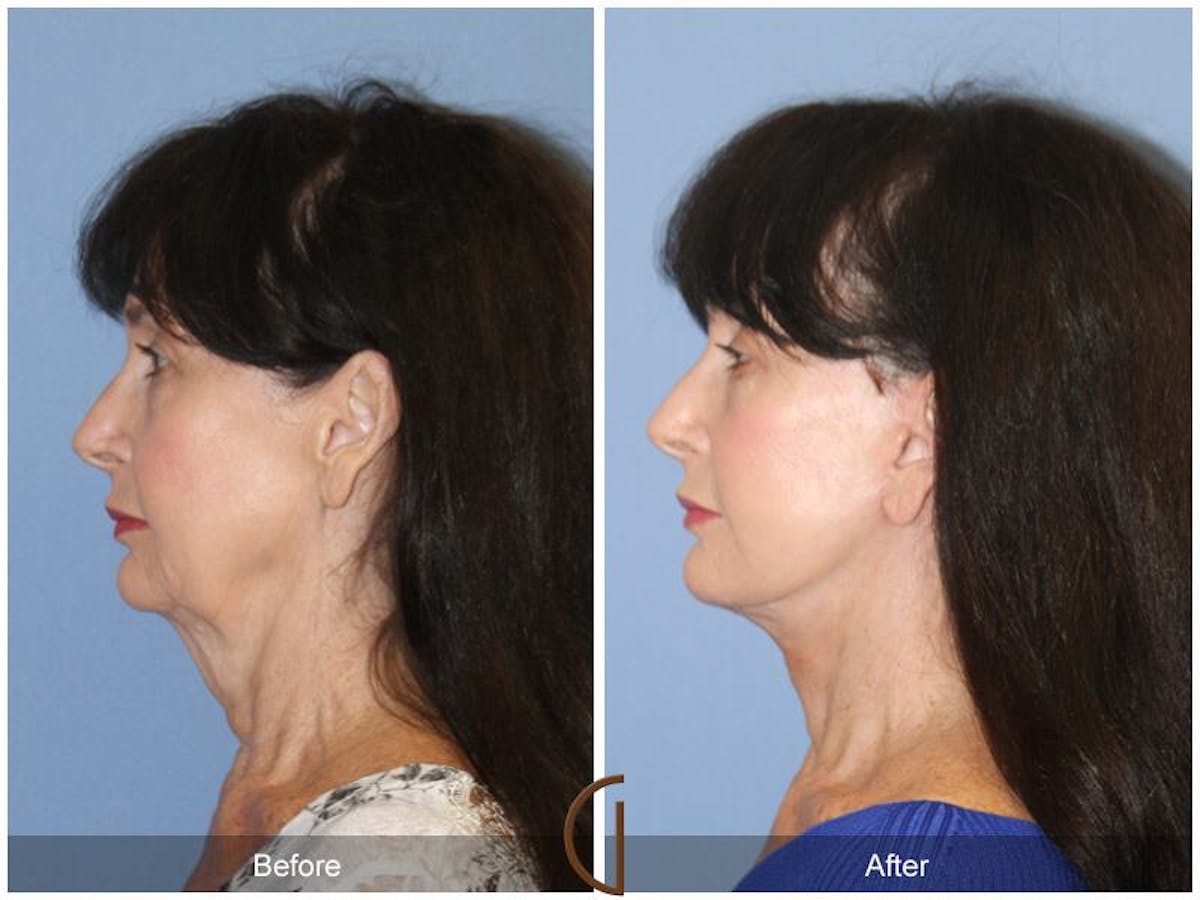 Facelift 60s Before & After Gallery - Patient 221226 - Image 1