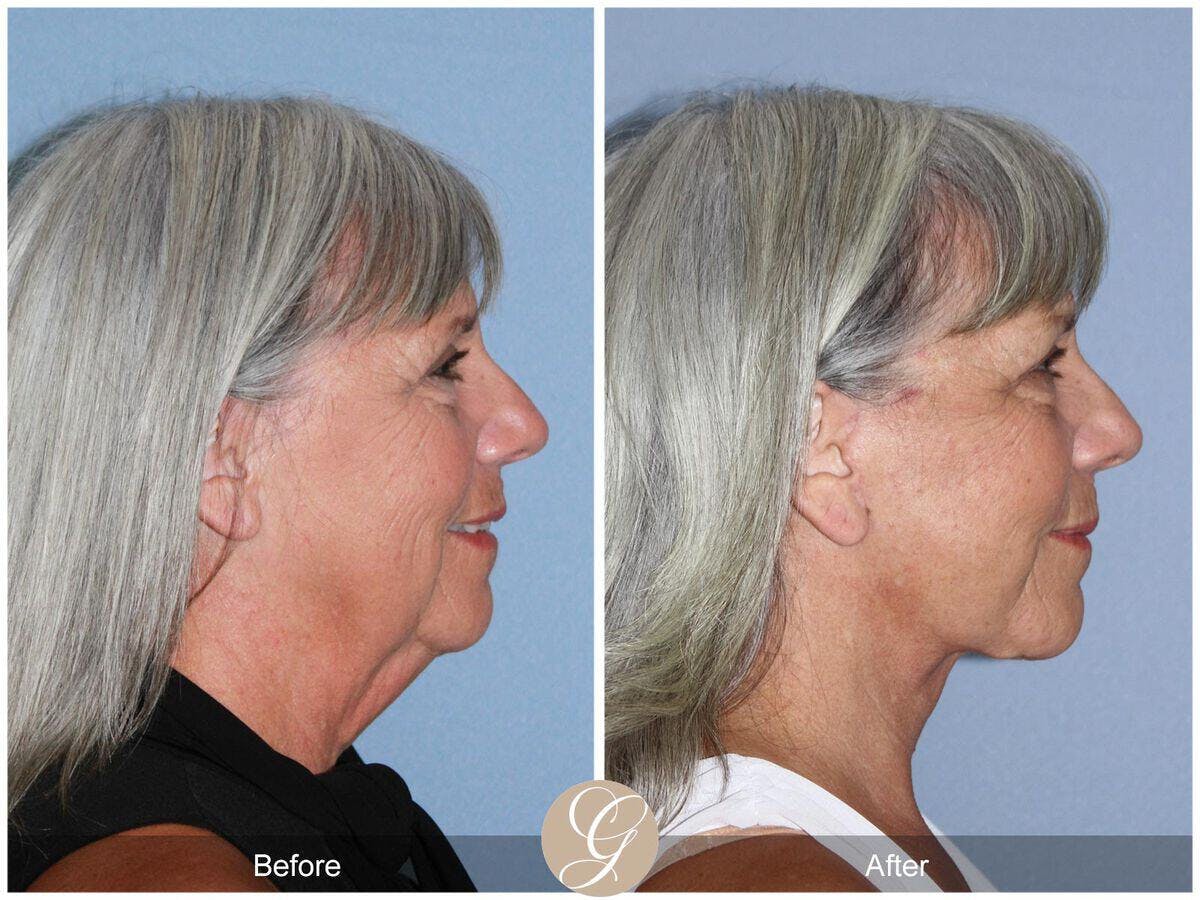 Facelift 60s Before & After Gallery - Patient 239746 - Image 3
