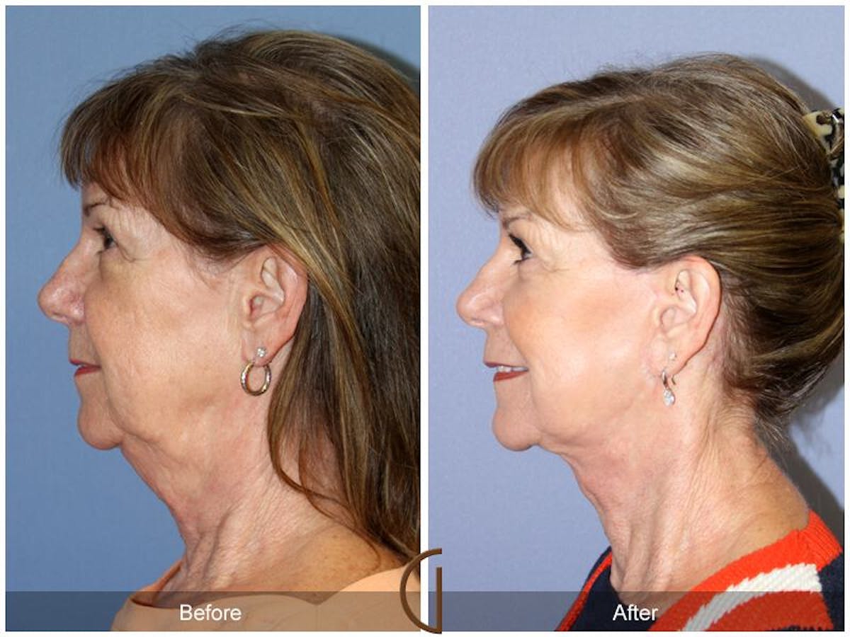 Facelift 60s Before & After Gallery - Patient 639286 - Image 1