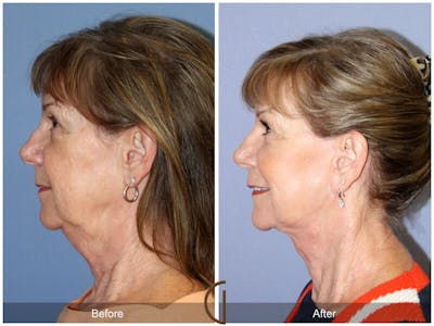 Neck Lift Before & After Gallery - Patient 803684 - Image 1