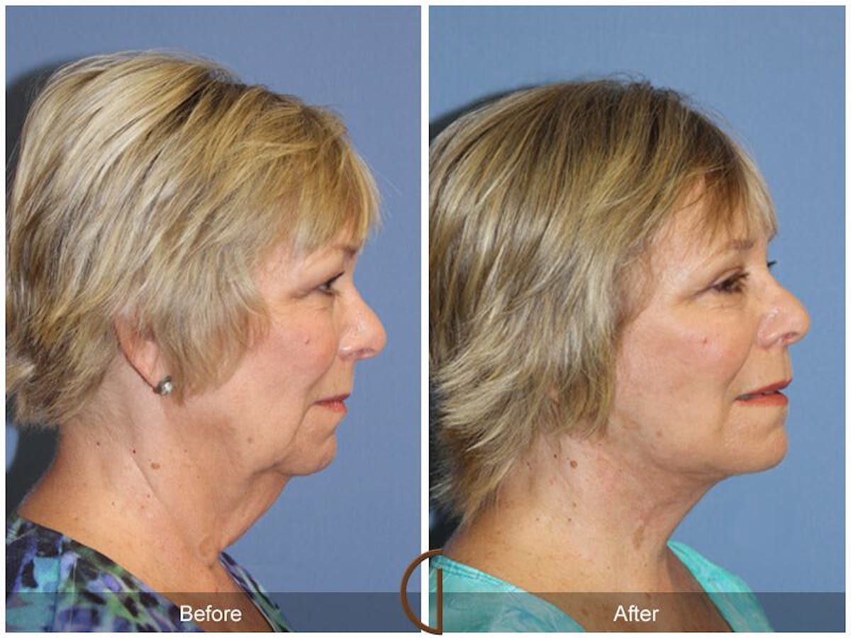 Facelift 60s Before & After Gallery - Patient 229789 - Image 3