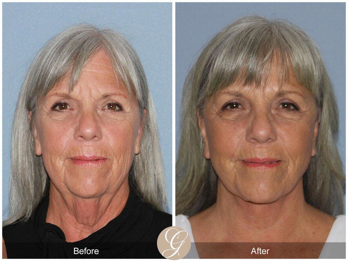 Facelift 60s Before & After Gallery - Patient 239746 - Image 2
