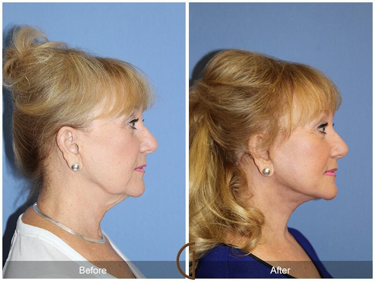 Facelift 60s Before & After Gallery - Patient 676571 - Image 3