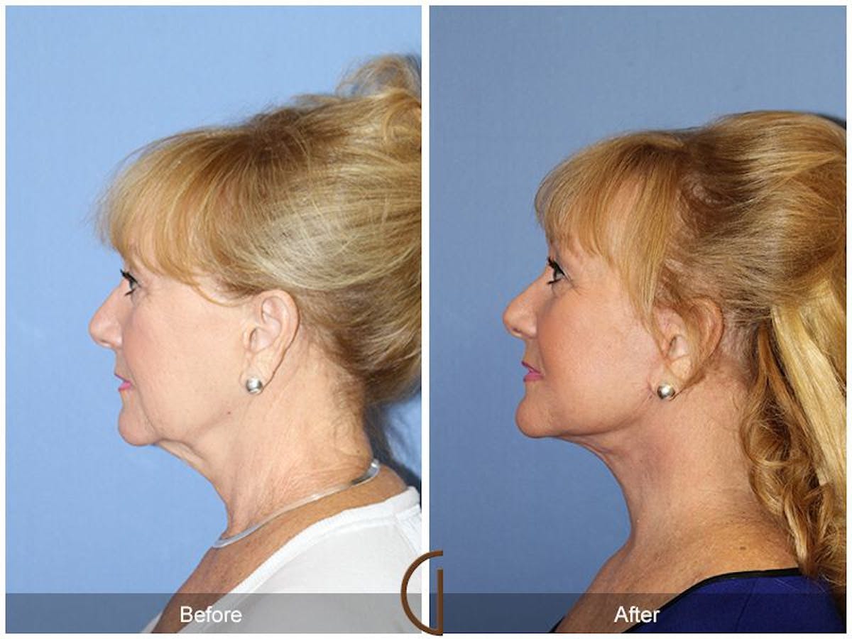 Facelift 60s Before & After Gallery - Patient 676571 - Image 1