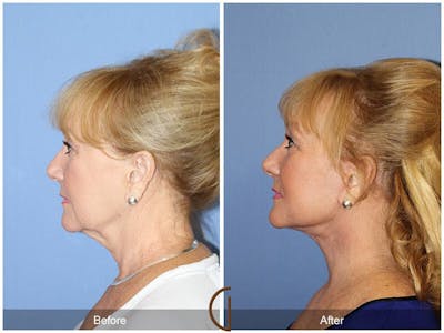 Neck Lift Before & After Gallery - Patient 372704 - Image 1