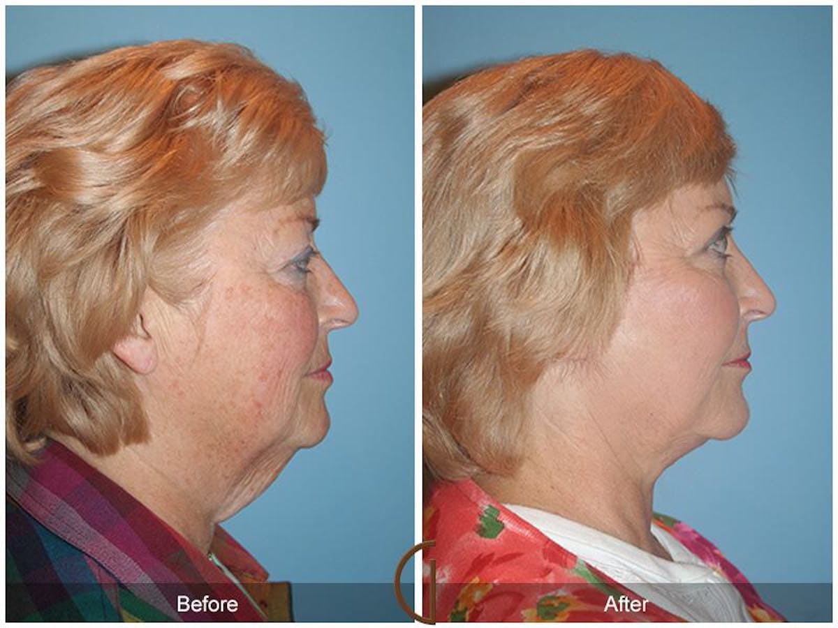 Facelift 60s Before & After Gallery - Patient 127670 - Image 3