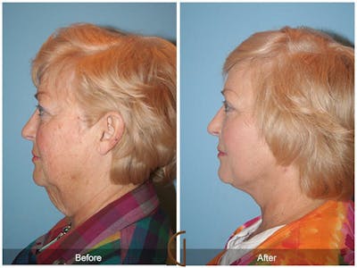 Neck Lift Before & After Gallery - Patient 220720 - Image 1