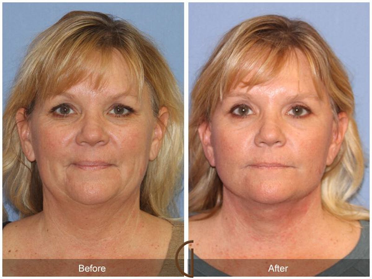 Facelift 40s Before & After Gallery - Patient 318198 - Image 2