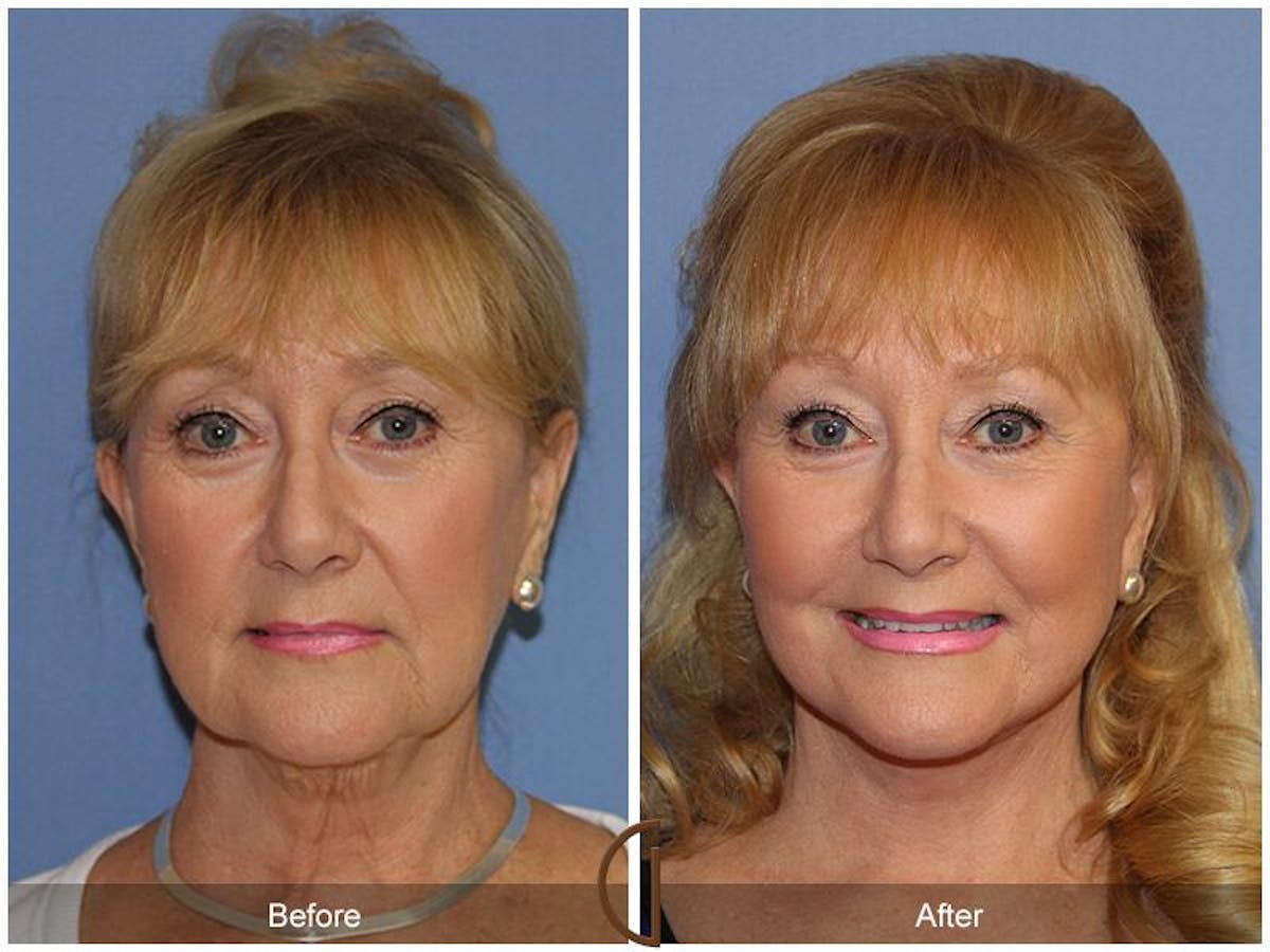 Facelift 60s Before & After Gallery - Patient 676571 - Image 2