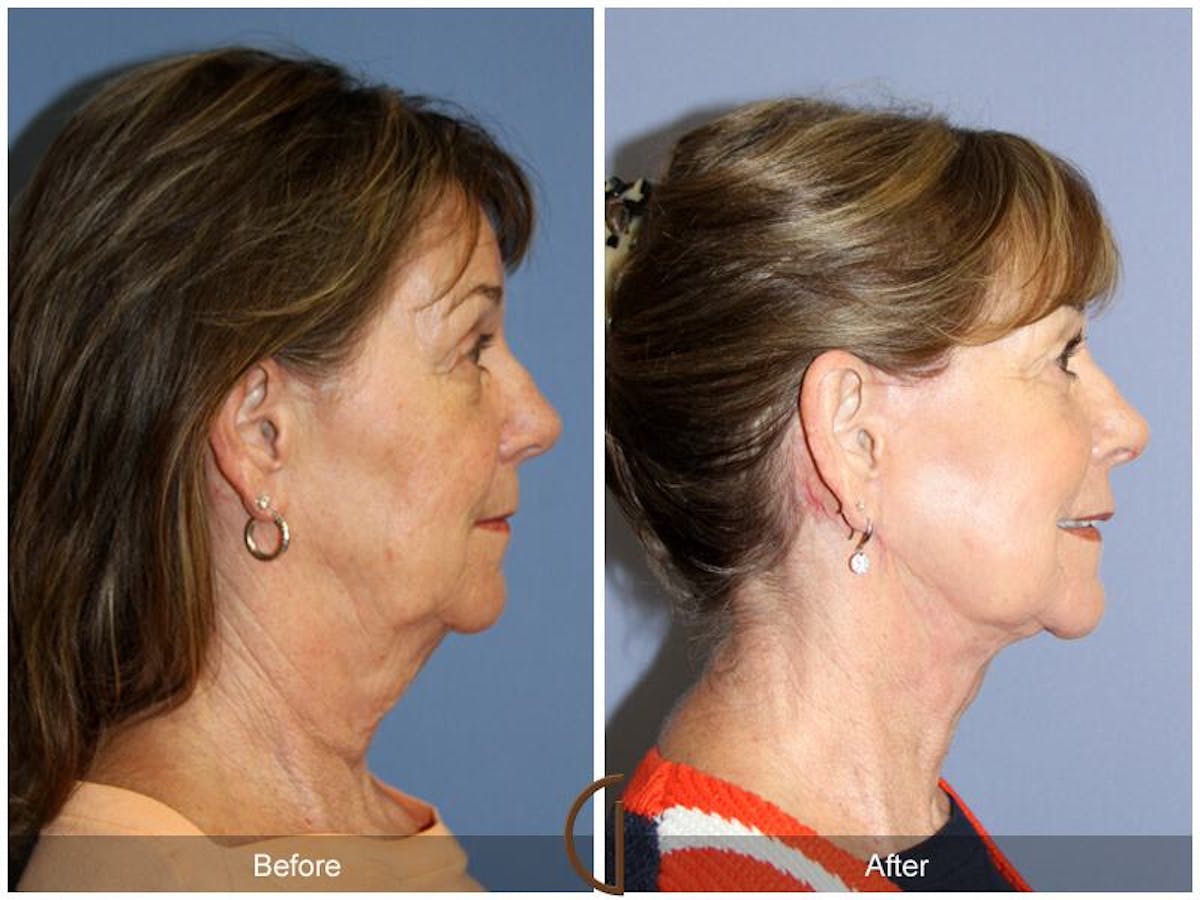 Facelift 60s Before & After Gallery - Patient 639286 - Image 3