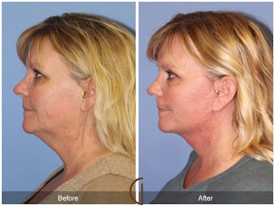 Neck Lift Before & After Gallery - Patient 315973 - Image 1