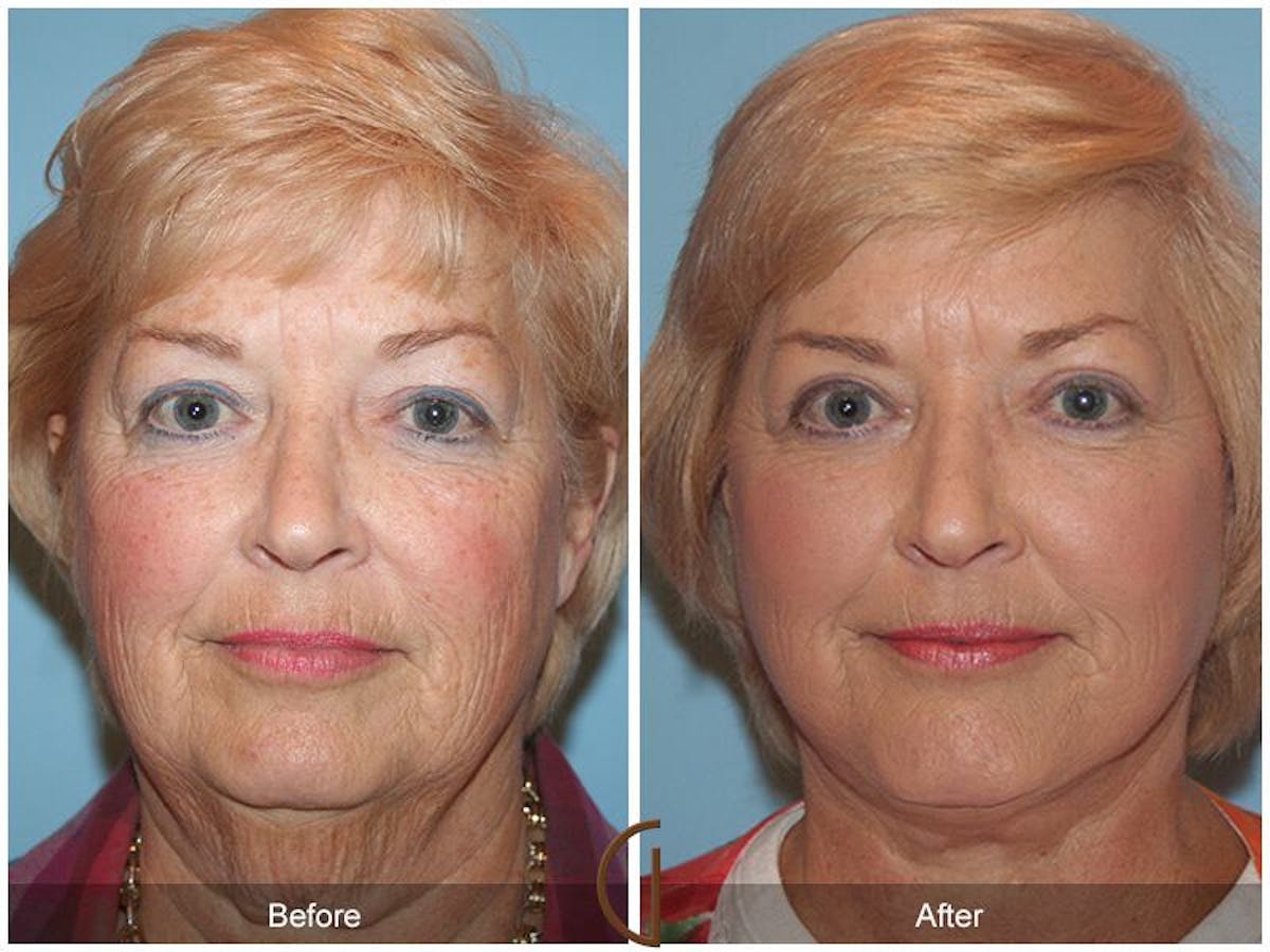 Facelift 60s Before & After Gallery - Patient 127670 - Image 2