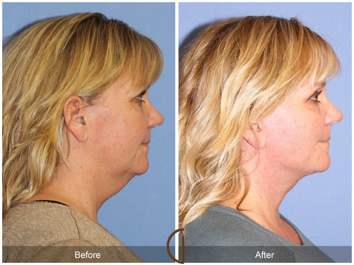 Facelift 40s Before & After Gallery - Patient 318198 - Image 3