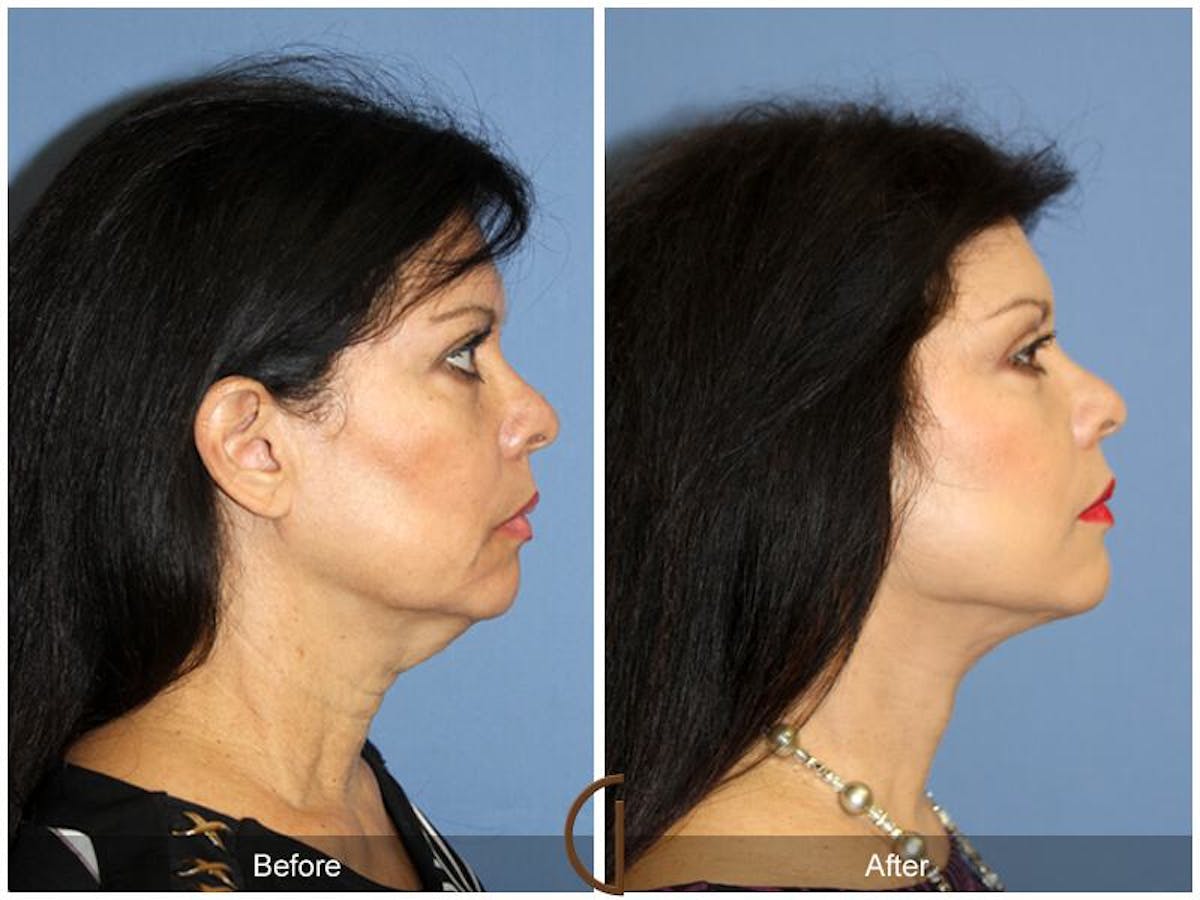 Facelift 50s Before & After Gallery - Patient 270922 - Image 3
