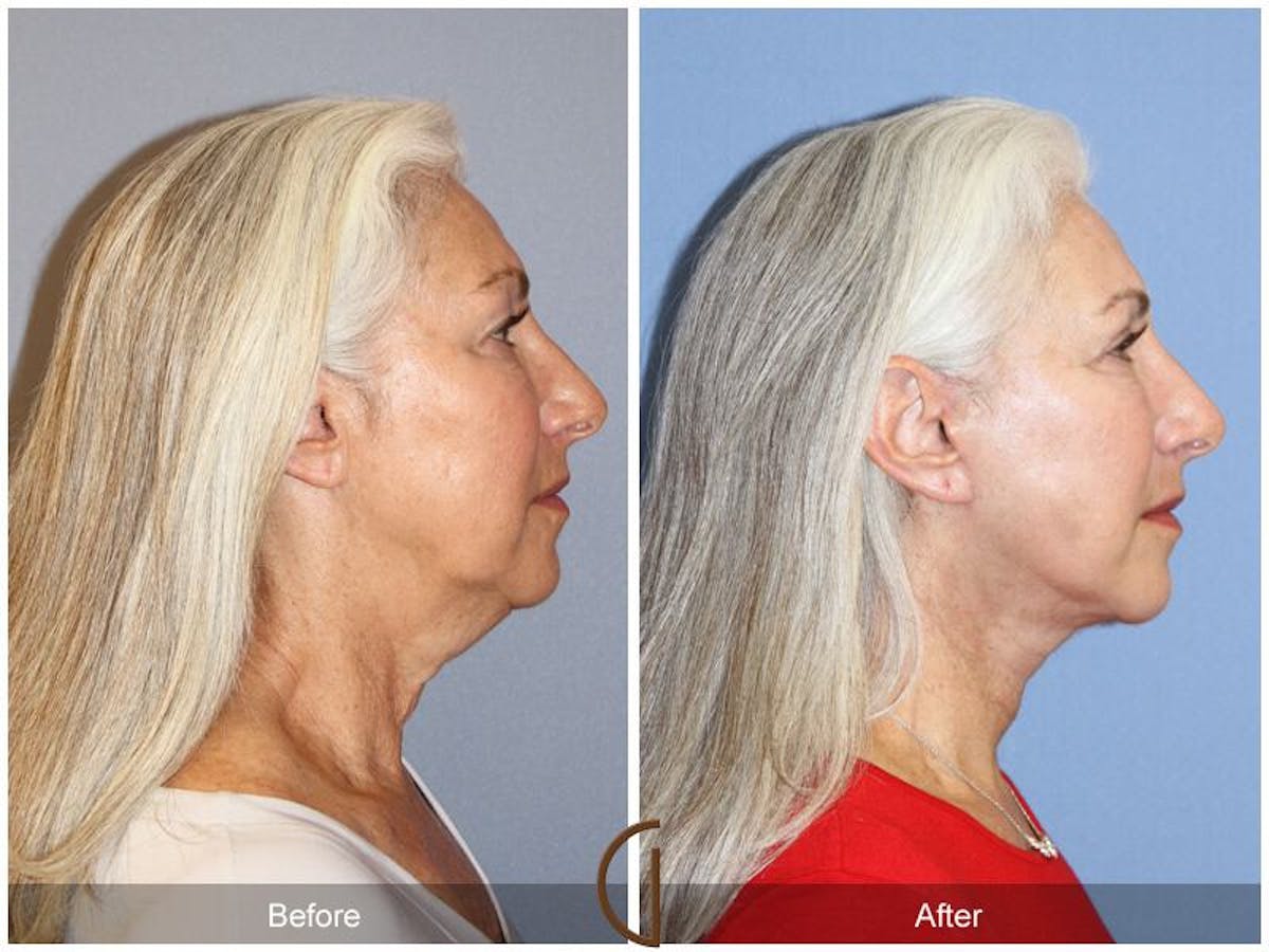 Facelift 60s Before & After Gallery - Patient 394657 - Image 3