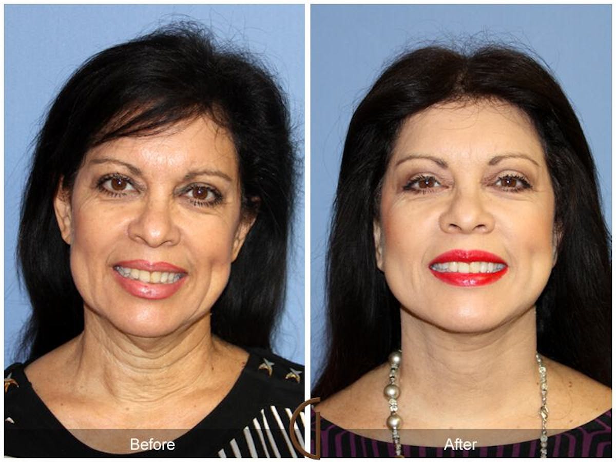 Facelift 50s Before & After Gallery - Patient 270922 - Image 2