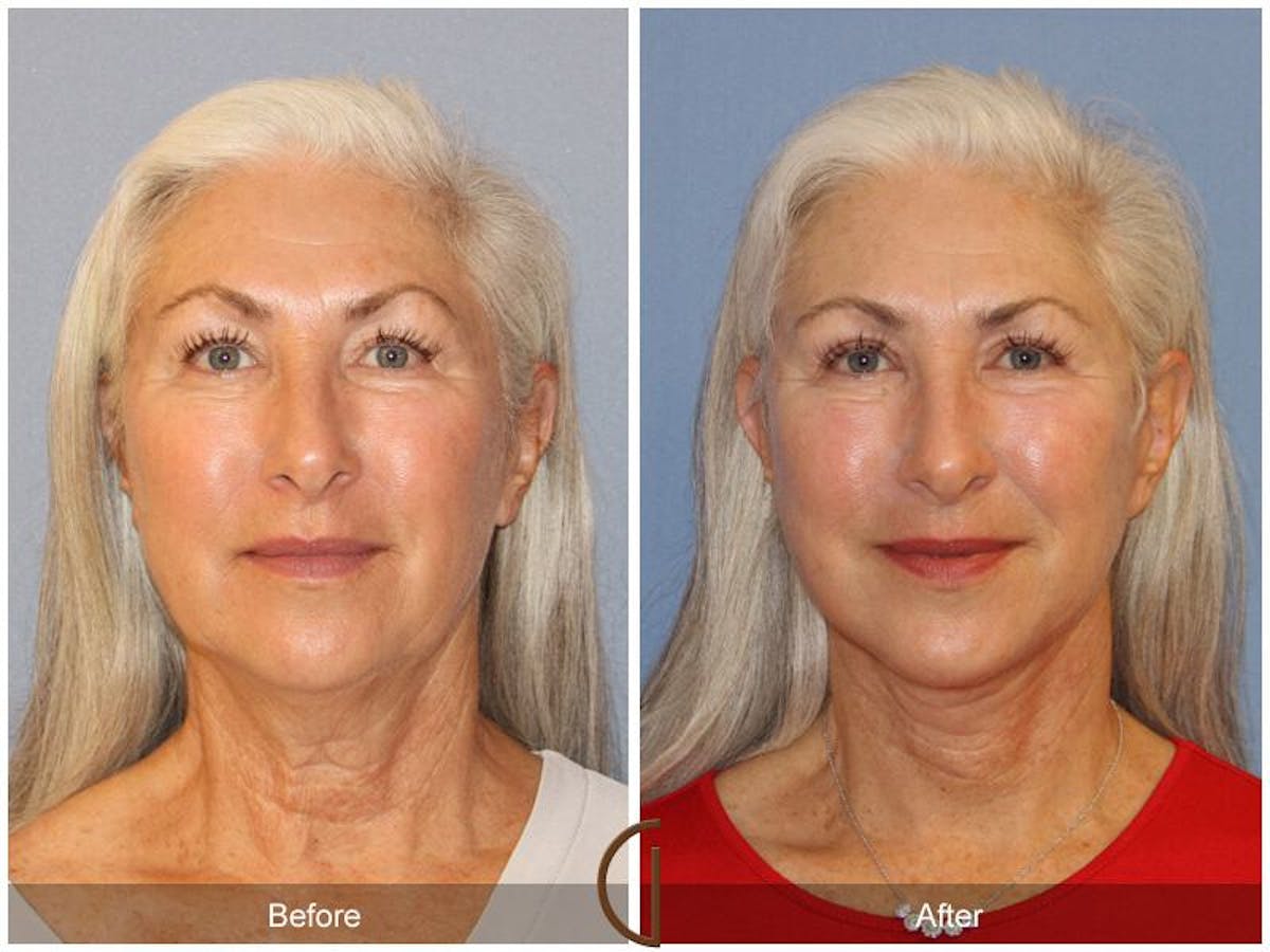 Facelift 60s Before & After Gallery - Patient 394657 - Image 2