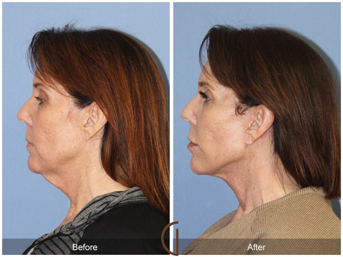 Facelift 50s Before & After Gallery - Patient 412124 - Image 1