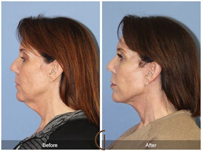 Facelift 50s Before & After Gallery - Patient 412124 - Image 1