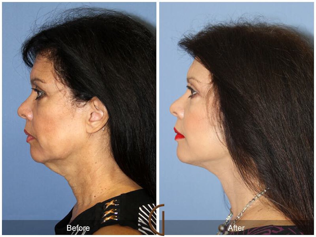 Facelift 50s Before & After Gallery - Patient 270922 - Image 1